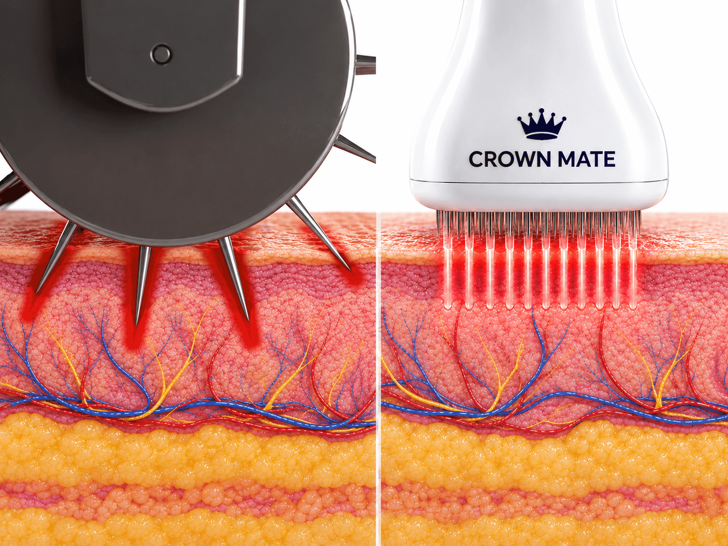 Illustration comparing a rolling derma roller with the Crownmate Serum Stamp pressing straight into the scalp